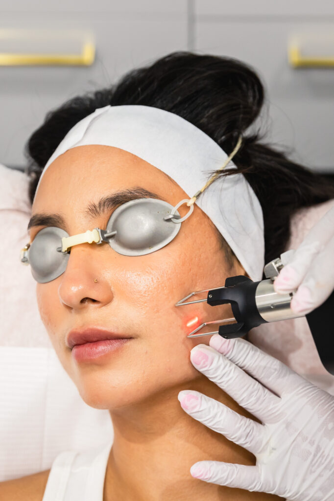 CO2 Laser Treatment being performed on face