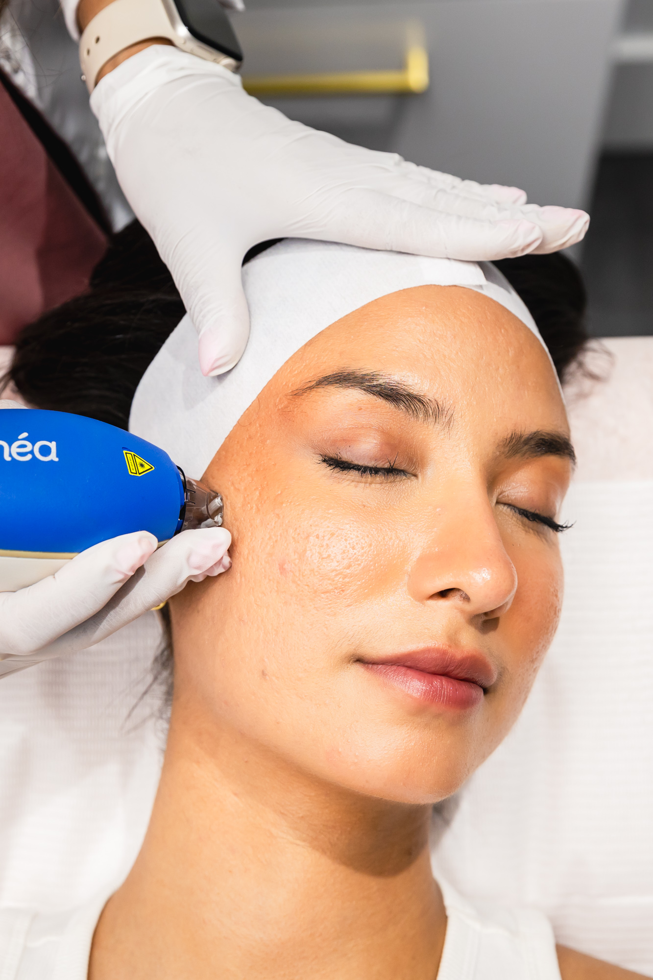 Clear and Brilliant laser treatment