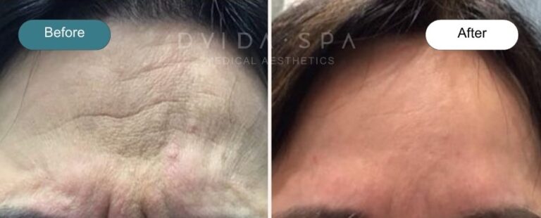 Botox in Chicago and near Raleigh before and after at Dvida Spa
