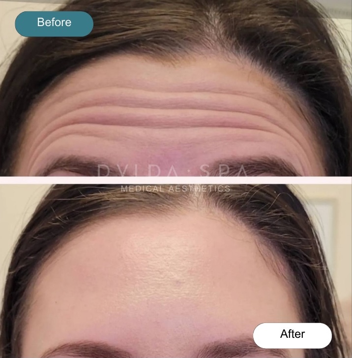Botox near Raleigh and in Chicago Before & After at DVIDA SPA