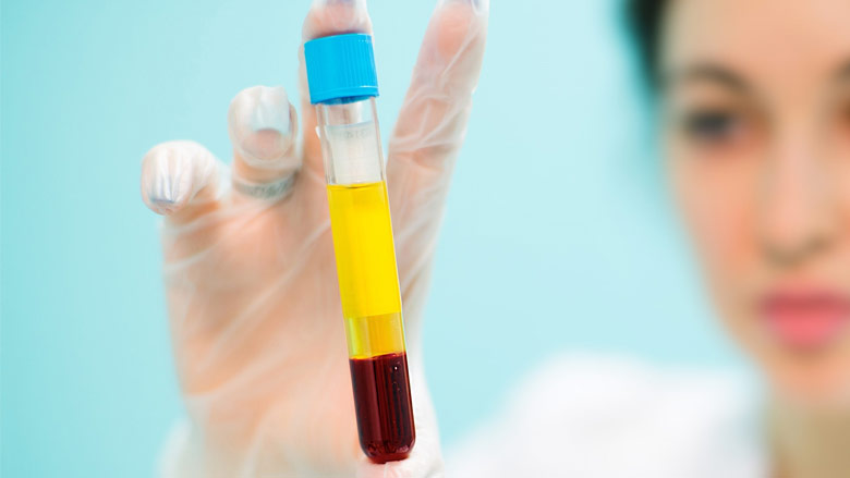 PLATELET RICH PLASMA