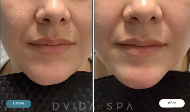 Chin Filler - Injectables